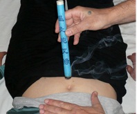 moxibustion3